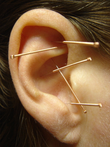 Typical auricular NADA (National Acupuncture Detoxification Association) protocol. Often used to treat addictions, but also reduces stress and anxiety.